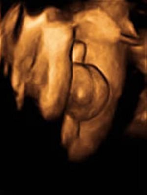3D-Ultraschallbild der Genitale eines männlichen Fötus