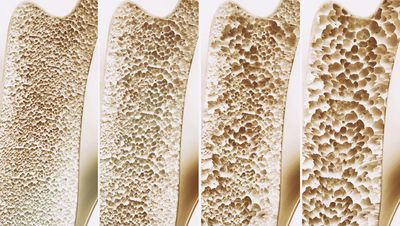 Knochenschwund – 4 Stadien der Osteoporose