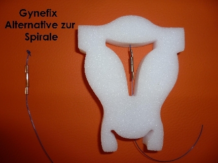 Erfahrungen kupferkette gynefix Kupferkette von
