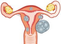 Myome können in verschiedenen Schichten der Gebärmutter wuchern